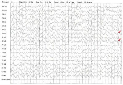 Case Report: A Case Report of Neurosyphilis Mimicking Limbic Encephalitis